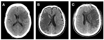 Evaluation and Prediction of Post-stroke Cerebral Edema Based on Neuroimaging